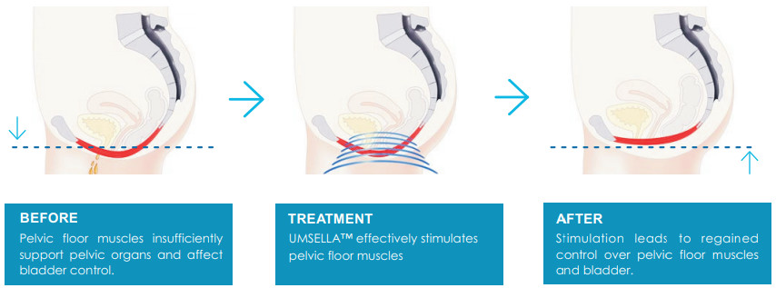 UMS Ella EMS 2800w Emslim 360 EMS Chair + 4 RF Handles Emslim 10 Tesla Emslim Pelvic Floor (1)