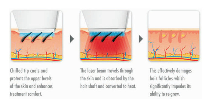 8# IPL&SHR&Elight Hair Removal Skin Rejuvenation Machine (1)