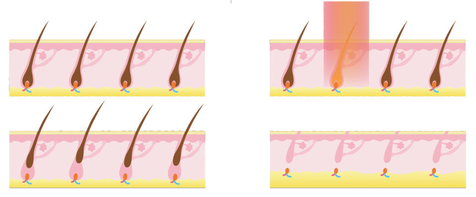 3#Underarms Area IPL SHR Hair Removal Machine Pain Free OEMODM Service
