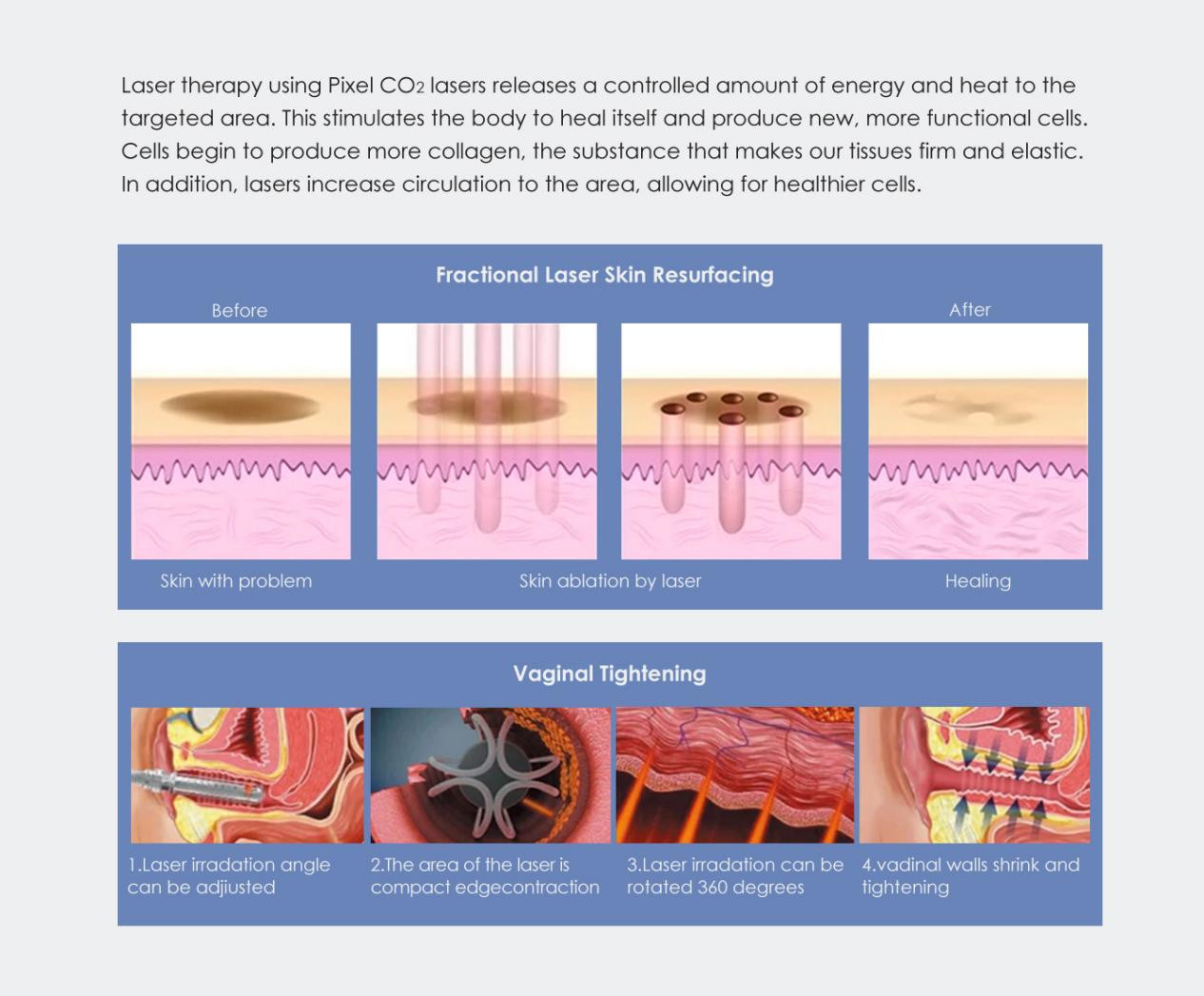 Co2 Laser Skin Resurfacing Laser Equipment Co2 Fractional Machine (4)