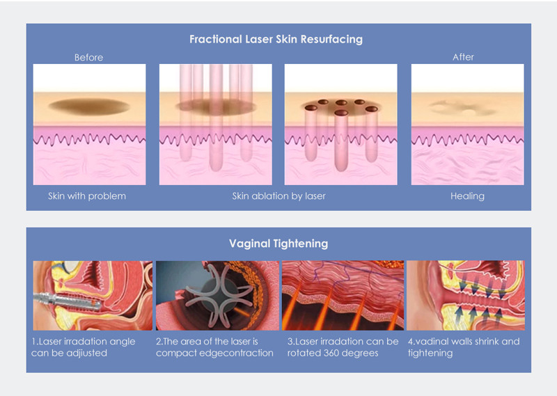 Co2 Fractional Laser Vaginal Tightening Skin Resurfacing Machine (2)