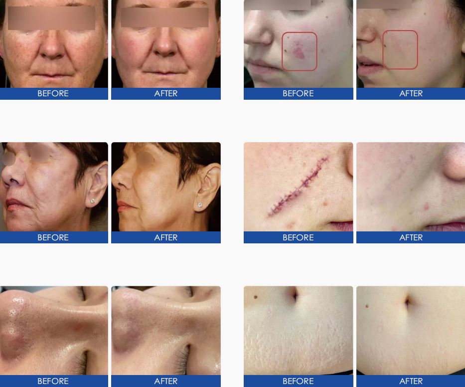 The Remarkable Applications of CO2 Fractional Laser Machine in Modern Beauty and Medical Science