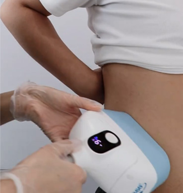 cryolipolysis machine feedback3